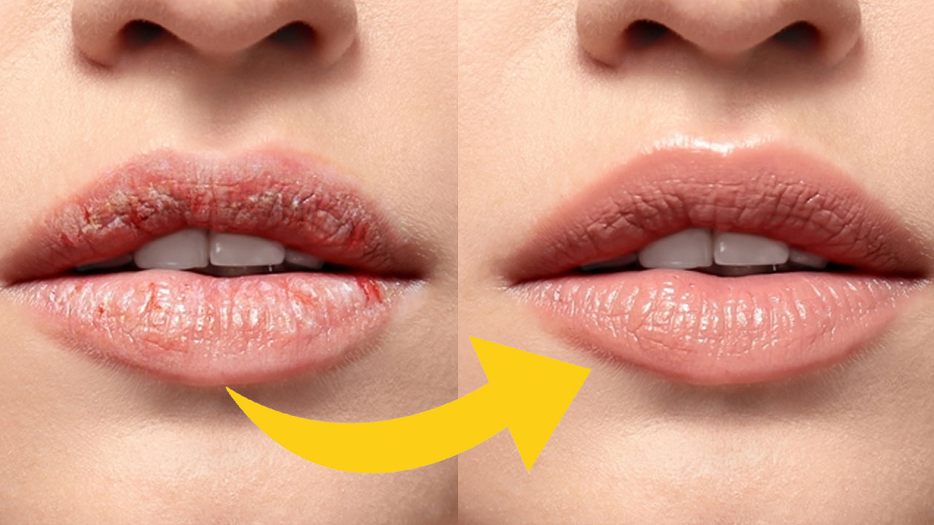 ফাটা ঠোঁট থেকে মুক্তি পাওয়ার ঘরোয়া উপায়